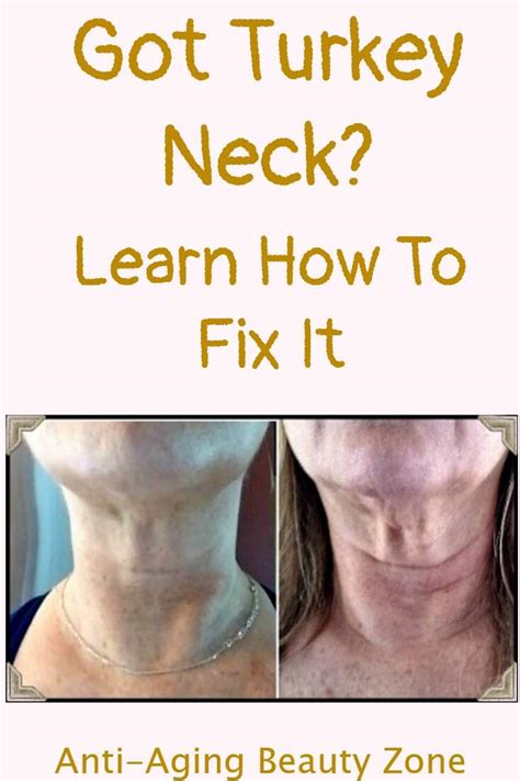 fat lady looks like a turkey|Eliminate Turkey Neck: Proven Tips & Treatments .